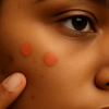 Acne Scars